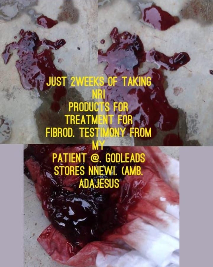 Fibroid-without-Sugery.jpeg